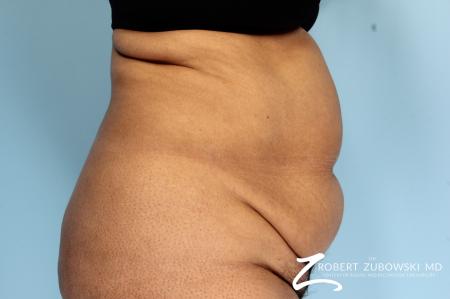 Tummy Tuck: Patient 18 - Before and After Image 2