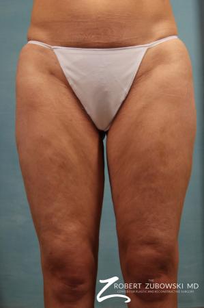 Cellulaze: Patient 2 - Before Image 1