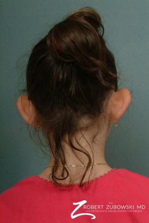 Otoplasty: Patient 4 - Before and After Image 2