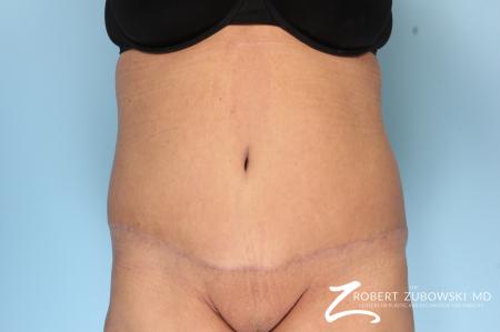 Tummy Tuck: Patient 19 - After Image 1