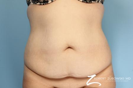 Tummy Tuck: Patient 17 - Before Image 1