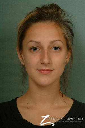 Rhinoplasty: Patient 11 - Before Image 1