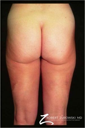 Liposuction: Patient 38 - After Image 1