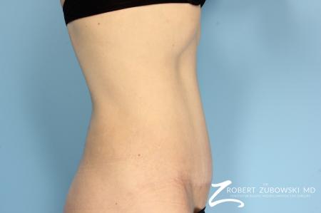 Tummy Tuck: Patient 12 - After Image 2