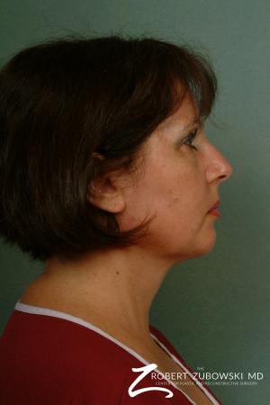 Neck Lift: Patient 8 - After Image 3
