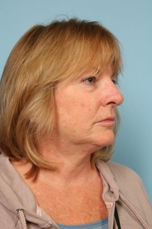 Mohs Closure: Patient 1 - After Image 1