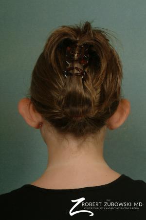 Otoplasty: Patient 3 - Before and After Image 2