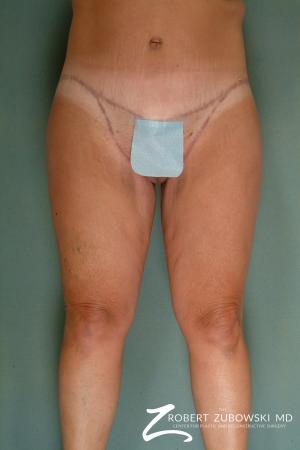 Body Lift: Patient 3 - After Image 1