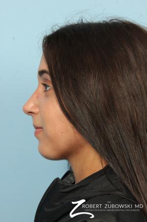 Rhinoplasty: Patient 24 - After Image 3
