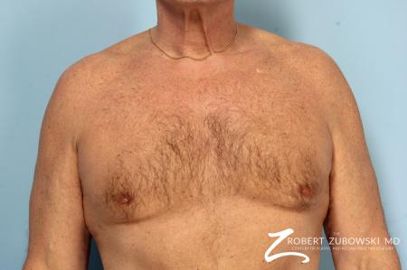 Gynecomastia: Patient 12 - After Image 1