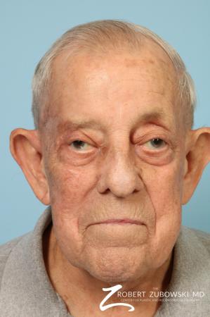 Mohs Closure: Patient 7 - After Image 1