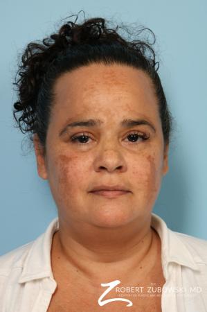 Laser: Patient 9 - Before Image 1