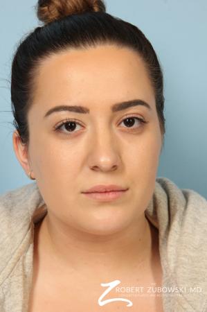 Rhinoplasty: Patient 21 - After Image 1