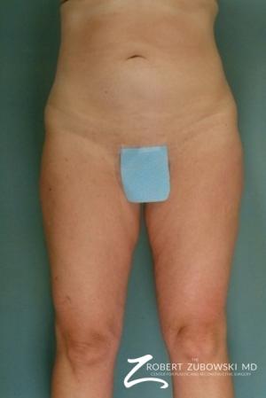 Liposuction: Patient 6 - After Image 1