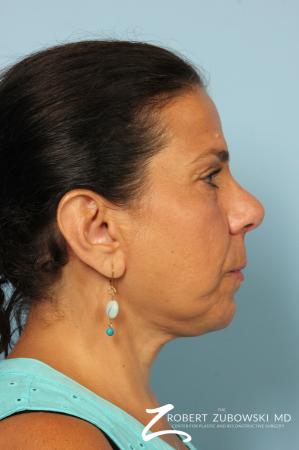 Chin Augmentation: Patient 4 - After Image 2