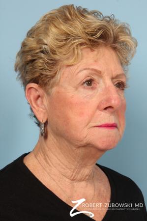 Blepharoplasty: Patient 30 - After Image 2