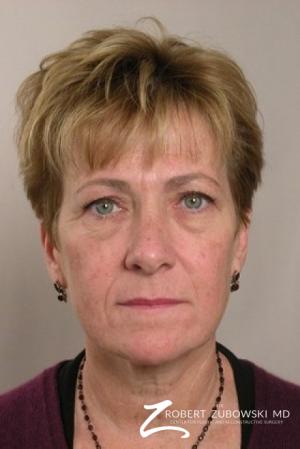 Blepharoplasty: Patient 6 - Before Image 1