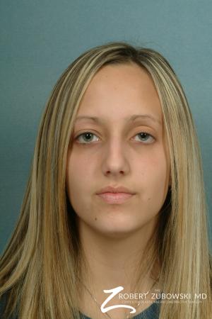 Rhinoplasty: Patient 9 - Before Image 1