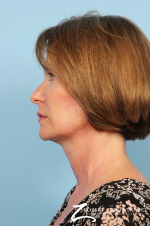 Ultherapy®: Patient 1 - After Image 2