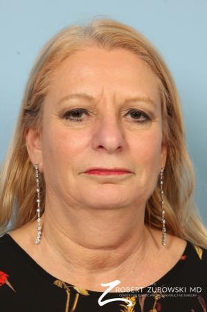 Blepharoplasty: Patient 17 - Before Image 1