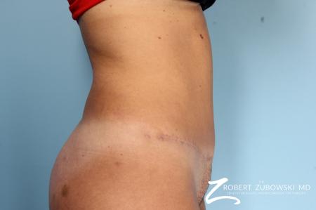 Tummy Tuck: Patient 9 - After Image 2