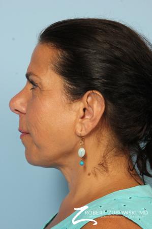 Chin Augmentation: Patient 4 - After Image 3