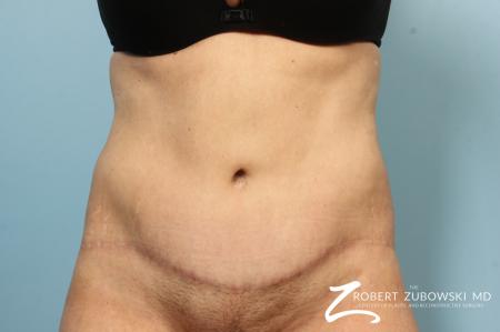 Body Lift: Patient 9 - After Image 1