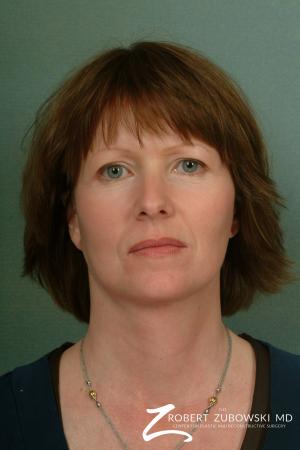Facelift: Patient 5 - After Image 1