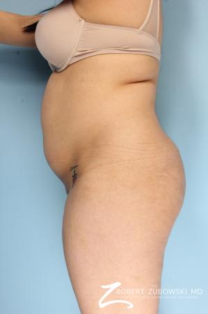 Butt Augmentation: Patient 4 - Before and After Image 2