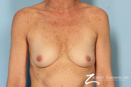 Breast Augmentation: Patient 39 - Before Image 1