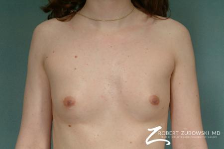 Breast Augmentation: Patient 19 - Before Image 1