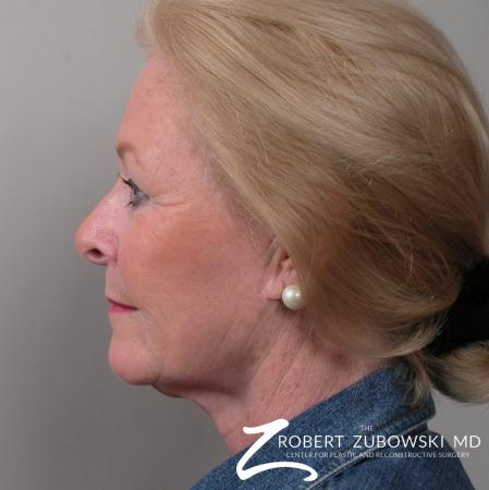 Facelift: Patient 16 - Before and After Image 2
