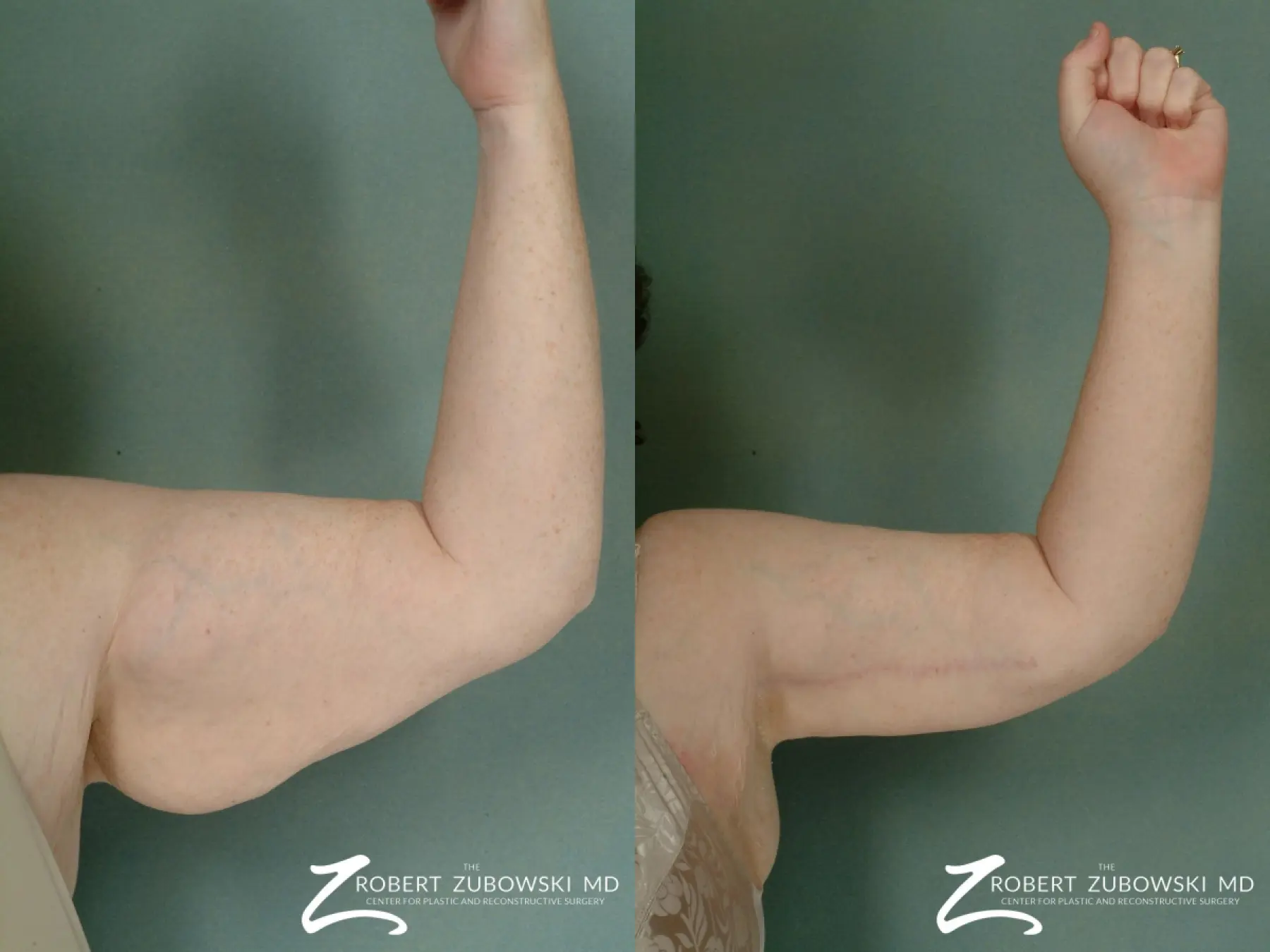 Arm Lift: Patient 2 - Before and After  