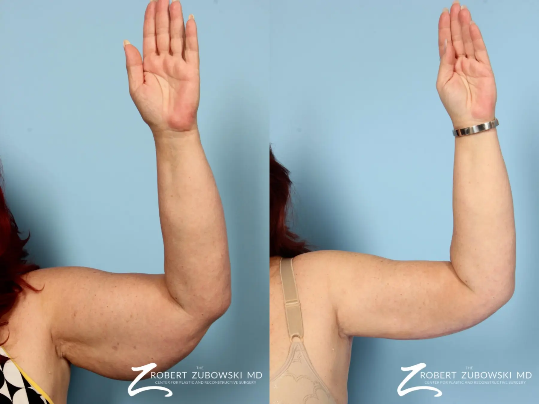 Arm Lift: Patient 3 - Before and After  