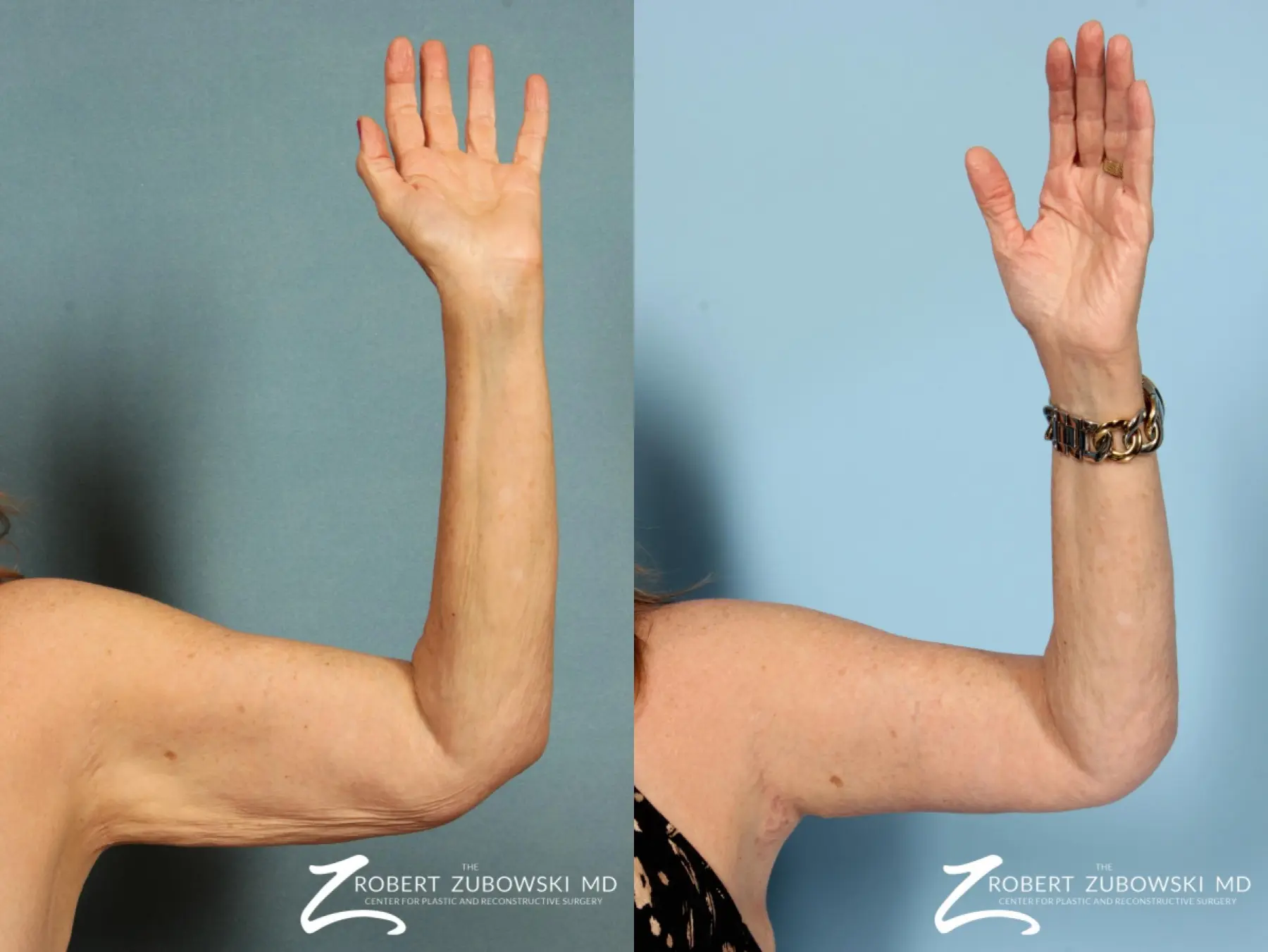 Arm Lift: Patient 1 - Before and After  