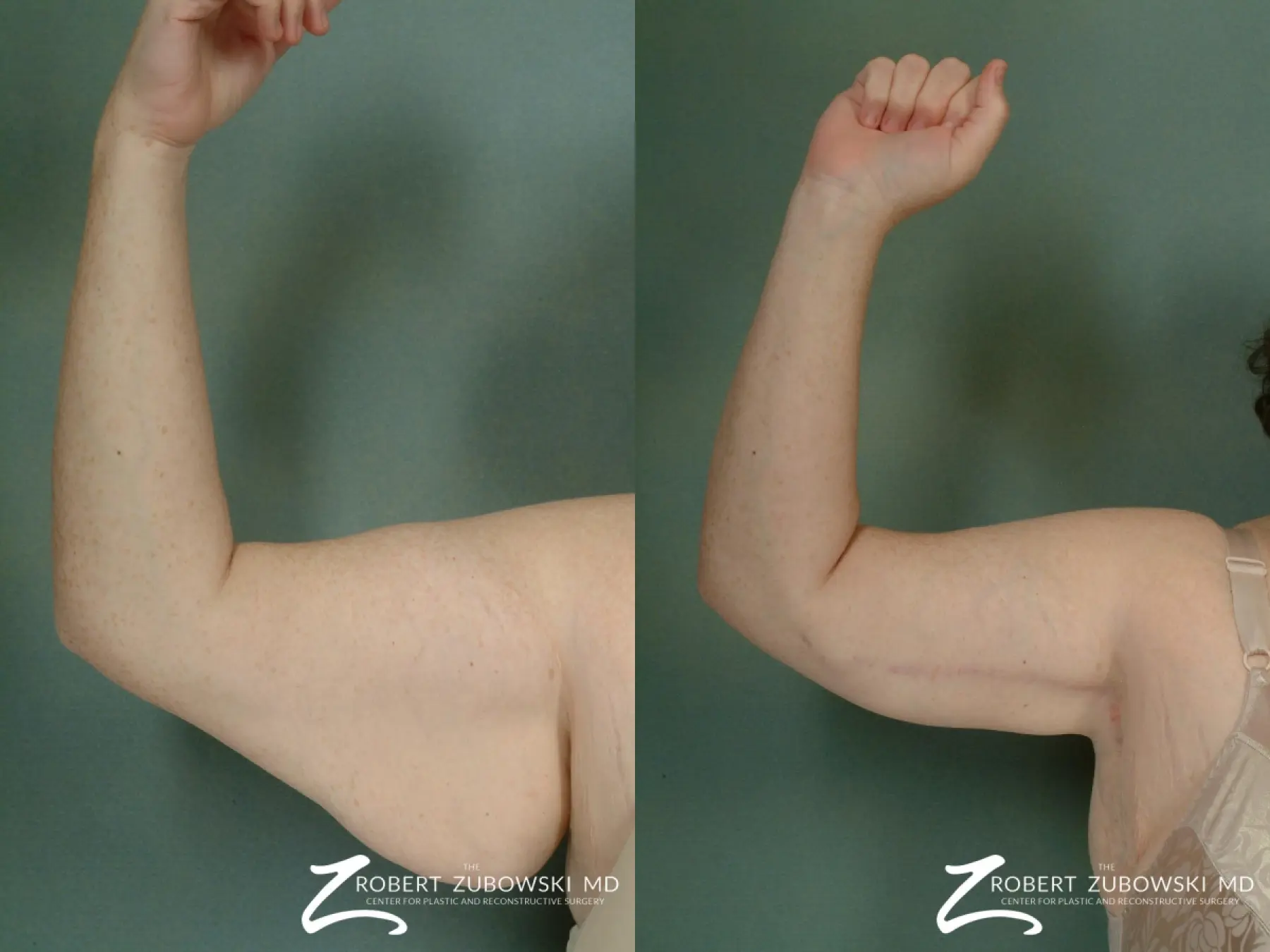 Arm Lift: Patient 2 - Before and After 3