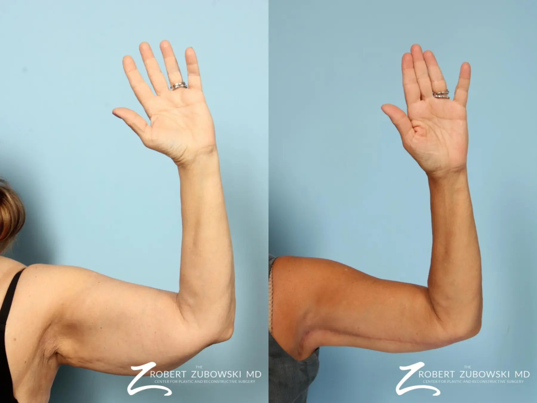 Arm Lift: Patient 4 - Before and After  