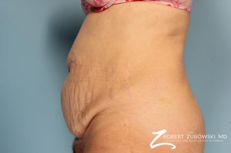 Tummy Tuck: Patient 16 - Before and After Image 2
