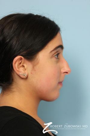Rhinoplasty: Patient 24 - Before Image 2