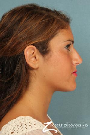 Rhinoplasty: Patient 19 - Before and After Image 2