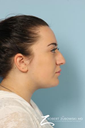 Rhinoplasty: Patient 21 - Before and After Image 3