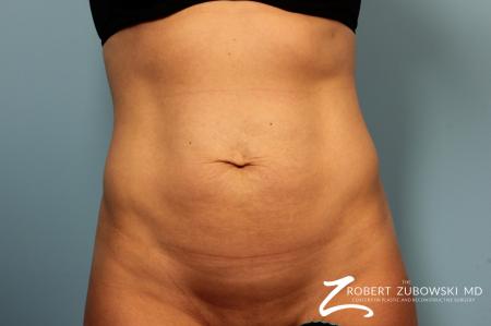 Tummy Tuck: Patient 14 - Before Image 1