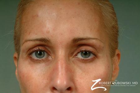 Latisse: Patient 3 - After Image 2