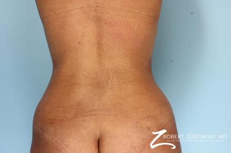 Liposuction: Patient 1 - After Image 2