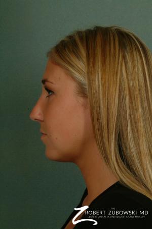 Rhinoplasty: Patient 1 - Before and After Image 2