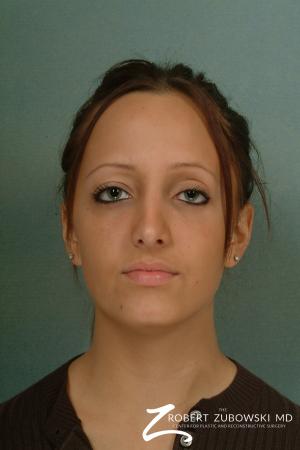 Rhinoplasty: Patient 9 - After Image 1