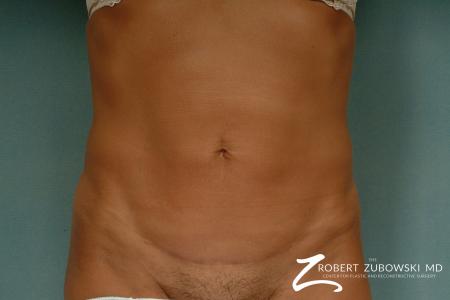 Liposuction: Patient 33 - After Image 1