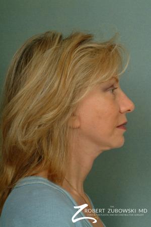 Facelift: Patient 13 - After Image 2