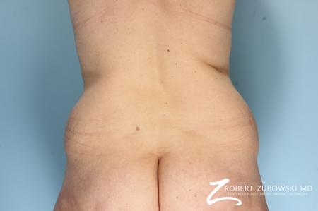 Liposuction: Patient 47 - Before Image 1