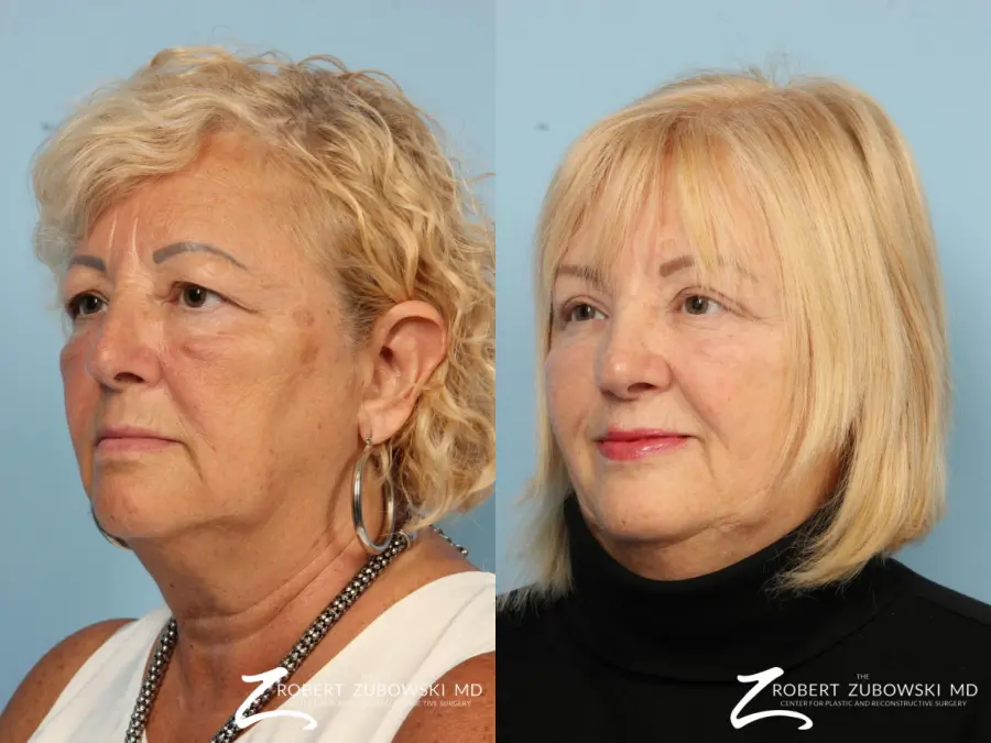 Blepharoplasty: Patient 16 - Before and After 2